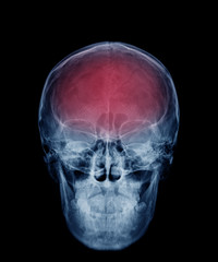 head skull x-ray front view in blue tone and area of brain show in red color