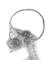 x-ray image of skull with blank area at brain , empty space in head , conceptual image of a open minded , can add text or object at brain area