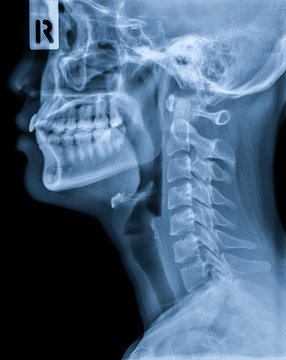 X-ray of neck and cervical spine side view. Image of radiography from patient who have neck pain, nerve root compression, numbness at arm hand wrist or finger