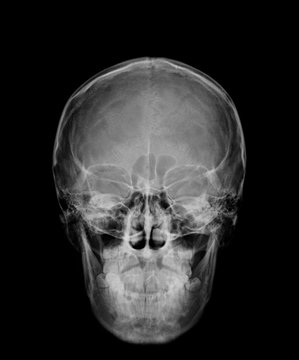 head skull x-ray front view