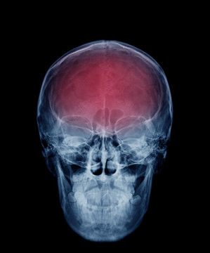 head skull x-ray front view in blue tone and area of brain show in red color