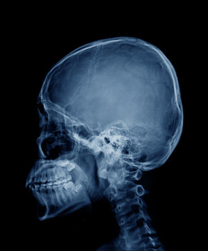 head skull x-ray side view in blue tone