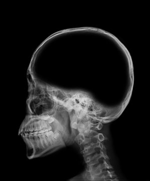 x-ray image of skull with blank area at brain , empty space in head , conceptual image of a open minded , can add text or object at brain area
