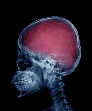 head skull x-ray side view in blue tone and area of brain show in red color