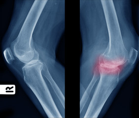 X-ray image show comparison of older normal knee on left side and osteoarthritis knee on right side side view. area of deformity with red color mark.