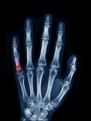 X-ray image of left hand show fracture at little finger upper view , area of broken with red color mark