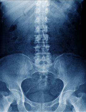 x-ray image of human normal spine, rips, pelvis, both hip joint
