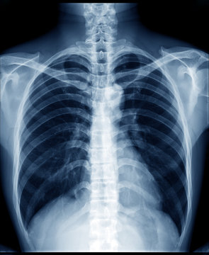 Chest x-ray of normal healthy man show lung, heart, spine, clavicle, diaphragm