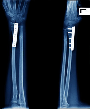 x-ray photo of broken arm ( fracture radius bone) orthopedic surgery internal fix by plate and screw