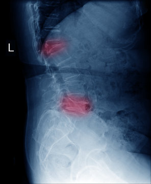 X-ray image side view of lumbar spines show deformity and compression fracture at red area mark and Scoliosis , ankylosing spondylitis