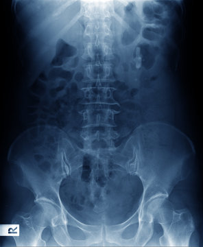x-ray image of human normal spine, rips, pelvis, both hip joint
