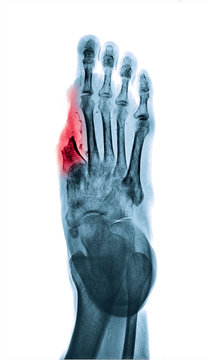 X-ray image of amputated big toe in diabetic patient. Reverse process to white tone.