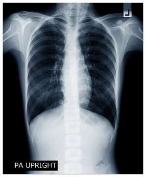 X-ray image of human body chest, very good quality