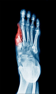 X-ray image of Diabetic wound ulcer show Big Toe amputation caused by wound infected.