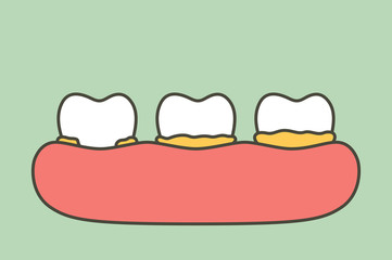 step of plaque or tartar , cause of tooth periodontal disease - dental cartoon vector flat style