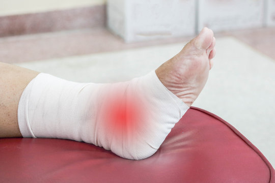 Foot pain, female heel intertwined with a cloth with red spots on chair red, plantar fasciitis.
