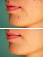 pimples on the skin of the girl close-up before after