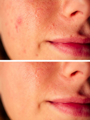 pimples on the skin of the girl close-up before after