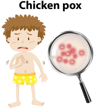A young kid with chicken pox