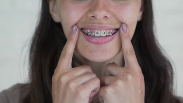 Young girl with braces on teeth looking at camera and smiling. Close up.