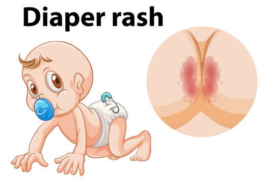 A baby with diaper rash