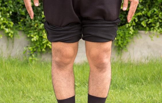 Asian man bandy-legged shape of the physiological bow leg