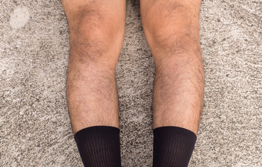 Asian man bandy-legged shape of the legs,Physiological bow leg,Close up