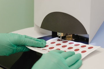 Preparation for analysis in samples of dry blood. Screening of newborns for hereditary metabolic diseases.