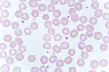 Red blood cells and platelet in blood smear, analyze by microscope
