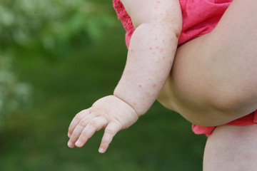 Baby rash caused by  fever, insect bite, skin allergy or heat reaction
