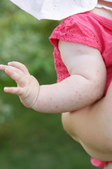 Baby rash caused by  fever, insect bite, skin allergy or heat reaction