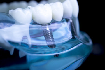 Dentist dental teeth implant
