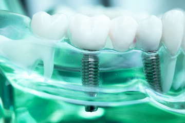 Dentist dental teeth implant