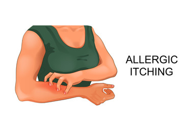 Allergic skin itching