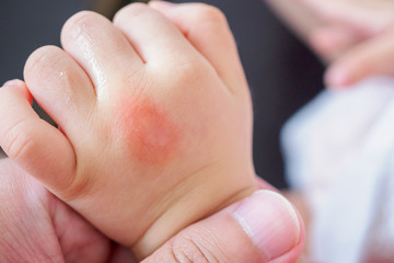 baby hand with skin rash and allergy with red spot cause by mosquito bite