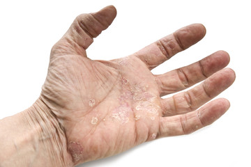 Psoriasis, skin disease on the joints of the body