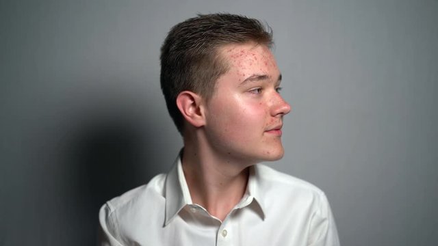 Young man with puberty acne problems looking at the camera in the studio on the grey background. Guy smiling and touching his allergic face skin. Young people in need of treatment. Skin care concept