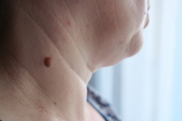 Adult woman with a large mole on her neck