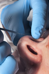 Dermatologist surgeon removes skin problems in the nose using electrocoagulation