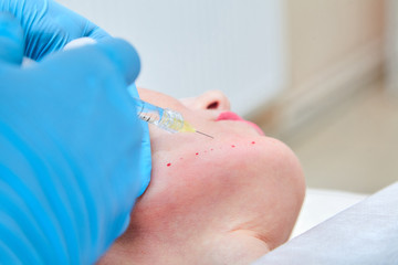 Injection cosmetology. The procedure of biorevitalization in the area of chin with a preparation...