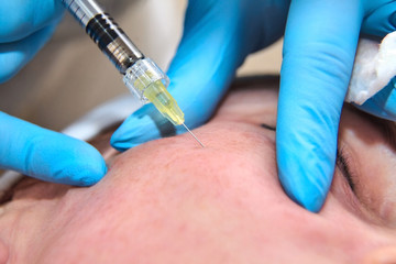 Injection cosmetology. The procedure of biorevitalization in the area of eyes with a preparation...