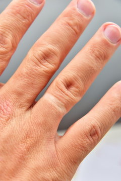 A trace from the wedding ring on the ring finger. The man broke
