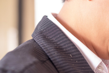 .Flaking dandruff from scalp psoriasis on neck of businessman. Healthcare people concept. - obrazy, fototapety, plakaty