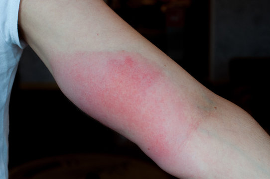 Red arm hurt. Skin allergy. Infection after bee sting.