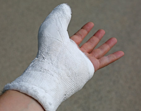 hand plastered after a fracture due to an accident
