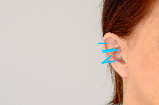 Close up of acupuncture needles in womans ear