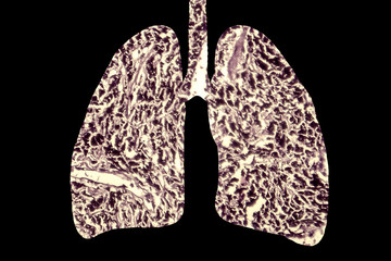 Smoker's lungs, medical concept, 3D illustration showing outline of lungs and light micrograph of smoker's lung tissue, photo under microscope