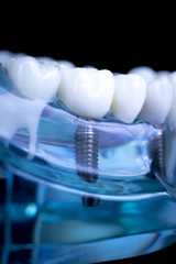 Dentist dental teeth implant