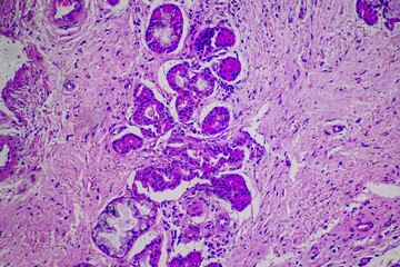 micrograph of human nasal polyp