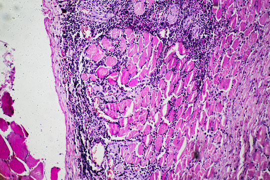 Eosinophilic Granuloma Of Human